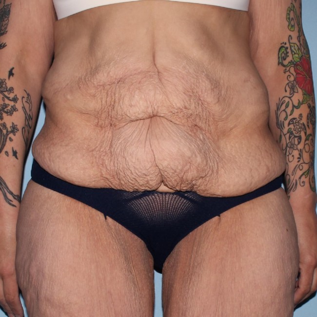 before fleur-de-lis abdominoplasty front view female patient case 7774