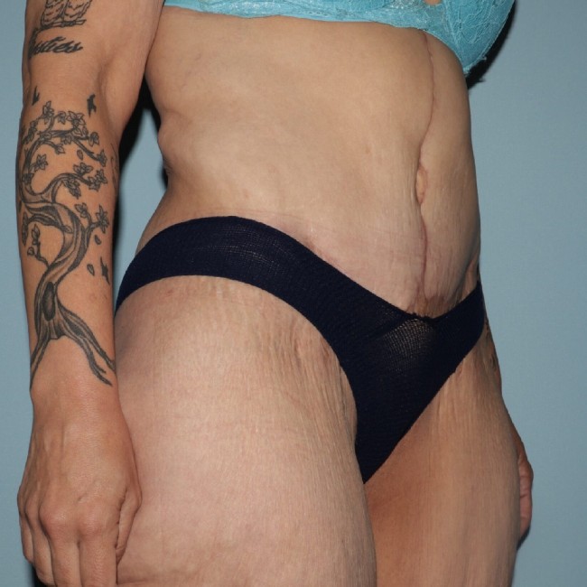 after fleur-de-lis abdominoplasty right angle view female patient case 7774