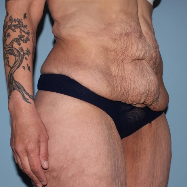 before fleur-de-lis abdominoplasty right angle view female patient case 7774