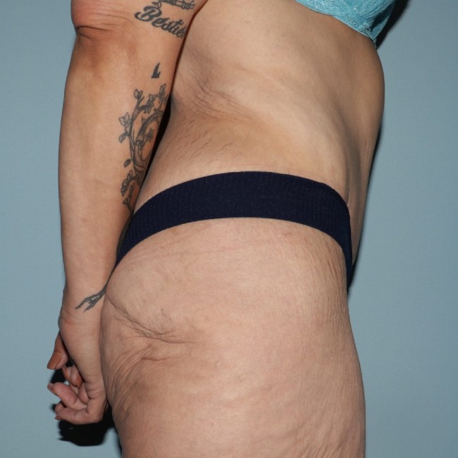after fleur-de-lis abdominoplasty right side view female patient case 7774