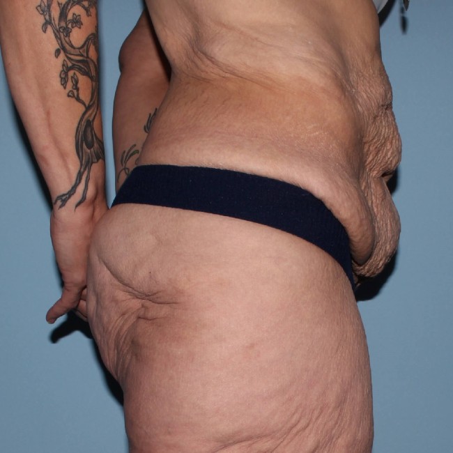 before fleur-de-lis abdominoplasty right side view female patient case 7774