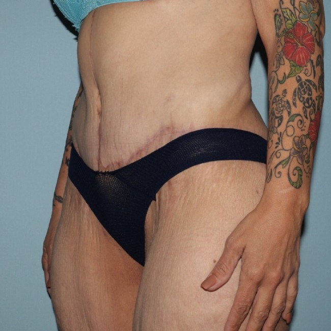 after fleur-de-lis abdominoplasty left angle view female patient case 7774