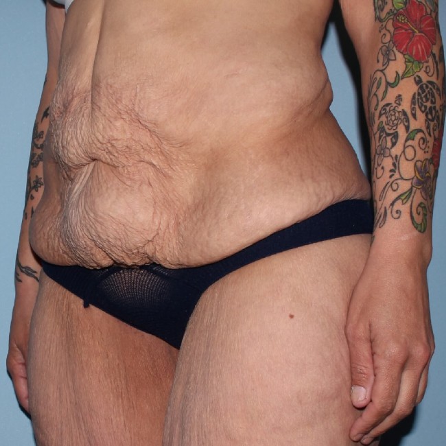 before fleur-de-lis abdominoplasty left angle view female patient case 7774