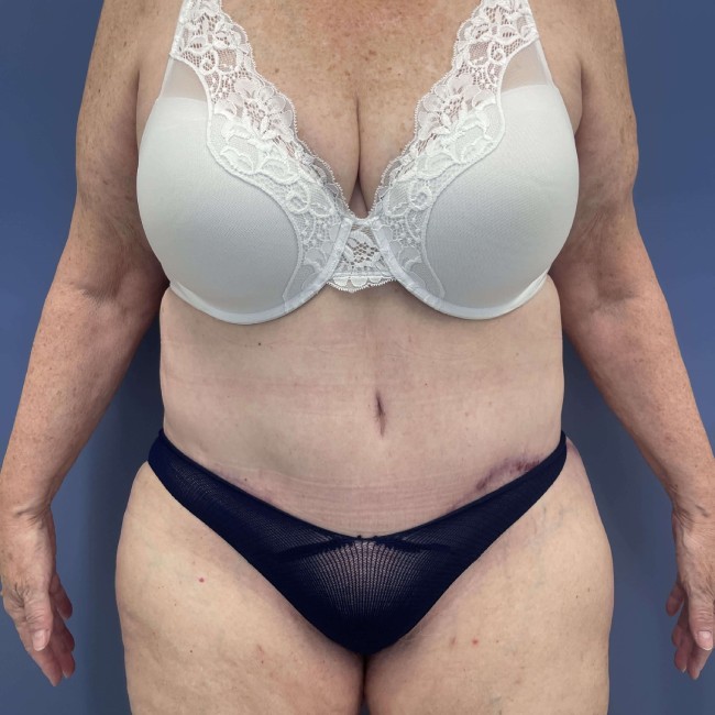 after Post Bariatric Body Contouring female patient front view case 7783