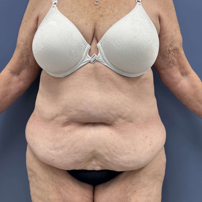 before Post Bariatric Body Contouring female patient front view case 7783