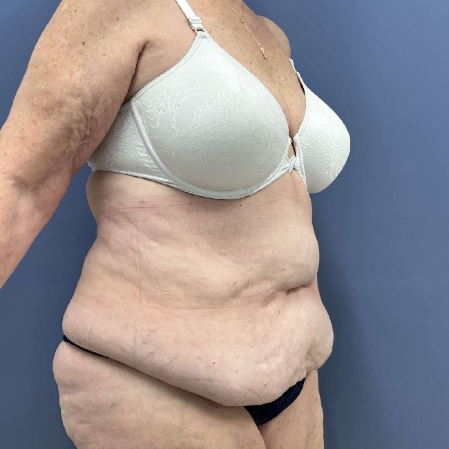 before Post Bariatric Body Contouring female patient right side view case 7783