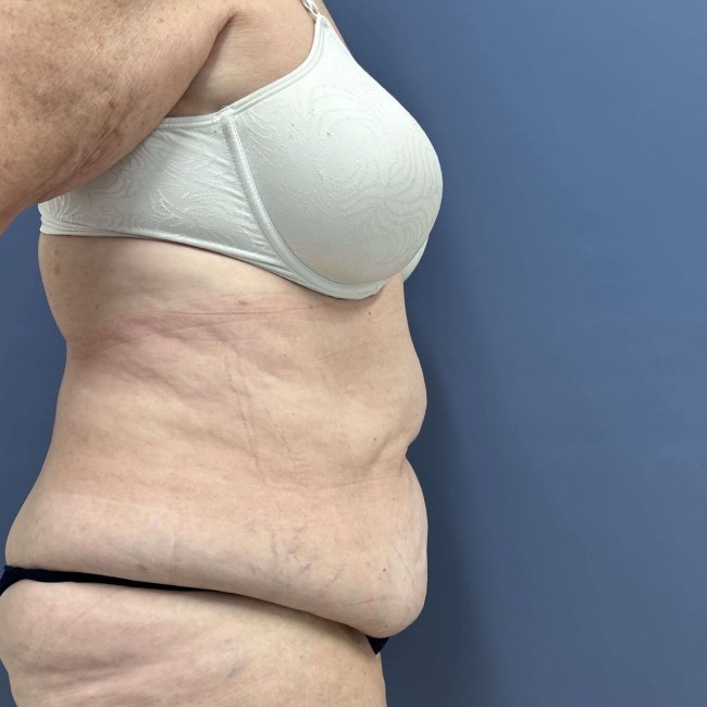 before Post Bariatric Body Contouring female patient right view case 7783