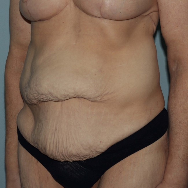 before Post Bariatric Body Contouring female patient left angle view case 7790