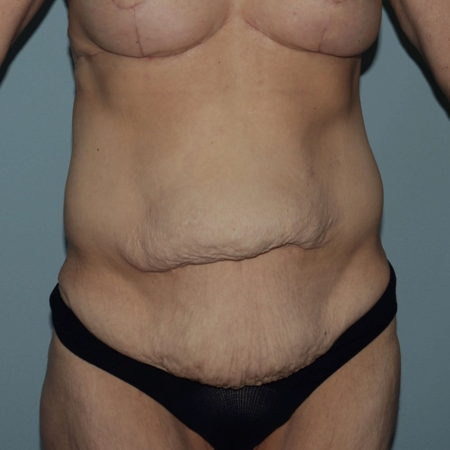 before Post Bariatric Body Contouring female patient front view case 7790