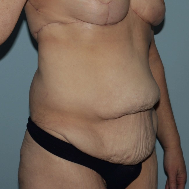 before Post Bariatric Body Contouring female patient right angle view case 7790