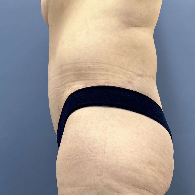 after Post Bariatric Body Contouring female patient left side view case 7790