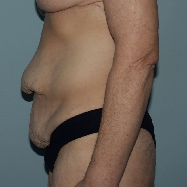 before Post Bariatric Body Contouring female patient left side view case 7790