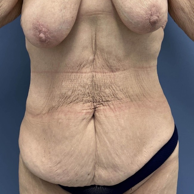 before After Weight Loss Surgery front view female patient case 7803