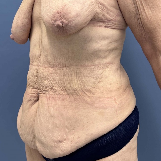 before After Weight Loss Surgery left angle view female patient case 7803