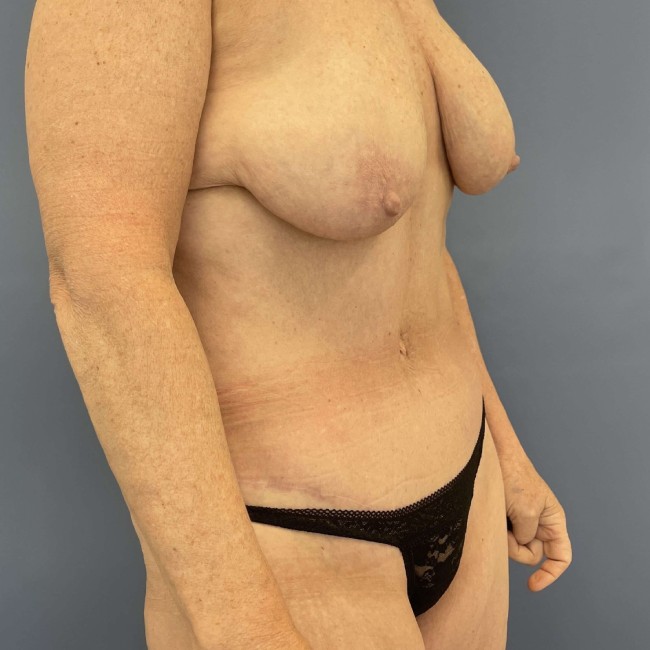 after After Weight Loss Surgery right angle view female patient case 7803