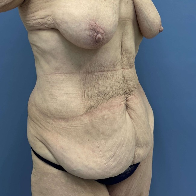before After Weight Loss Surgery right angle view female patient case 7803