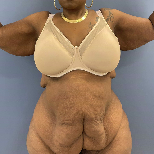 before After Weight Loss Surgery female patient front view arms out case 8225