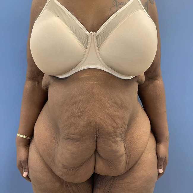 before After Weight Loss Surgery female patient front view case 8225