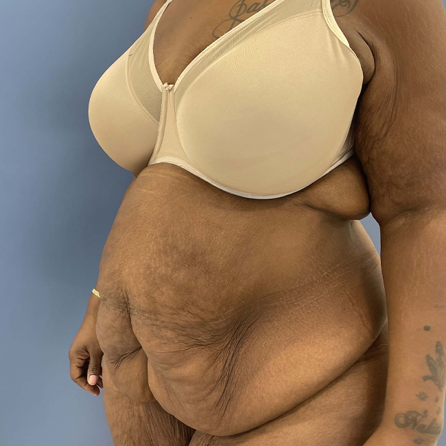 before After Weight Loss Surgery female patient left 45 angle view case 8225