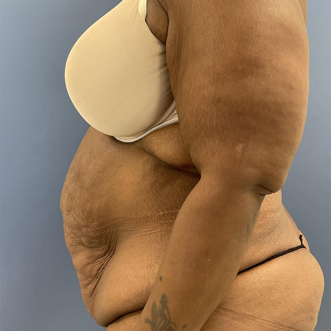 before After Weight Loss Surgery female patient left side view case 8225