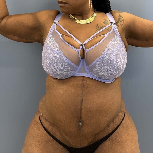 After Photo of After Weight Loss Surgery female patient front view case 8225