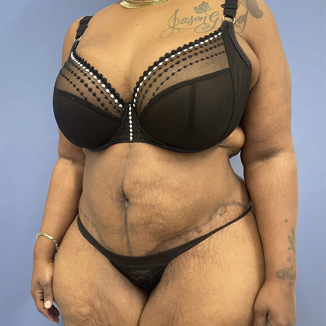 After Photo of After Weight Loss Surgery female patient Left 45 angle view case 8225