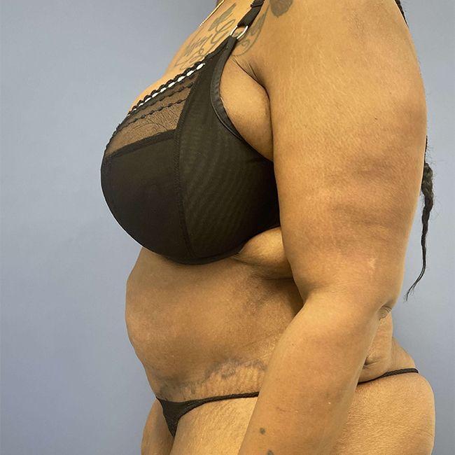 After Photo of After Weight Loss Surgery female patient left side view case 8225