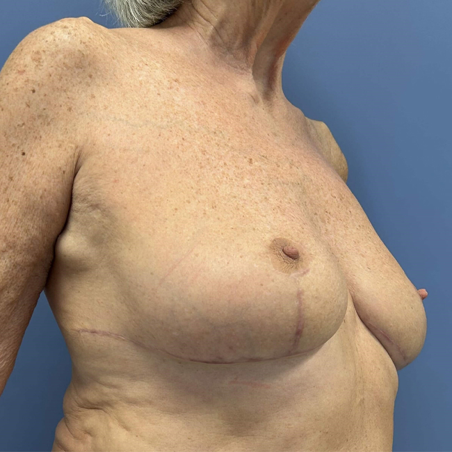after After Weight Loss Surgery female patient right angle view case 8226