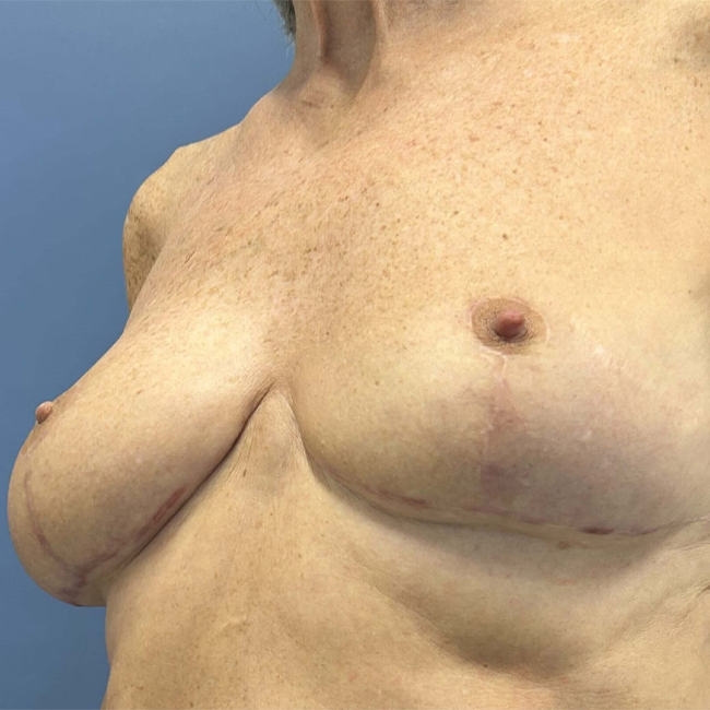 after After Weight Loss Surgery female patient left angle view case 8226