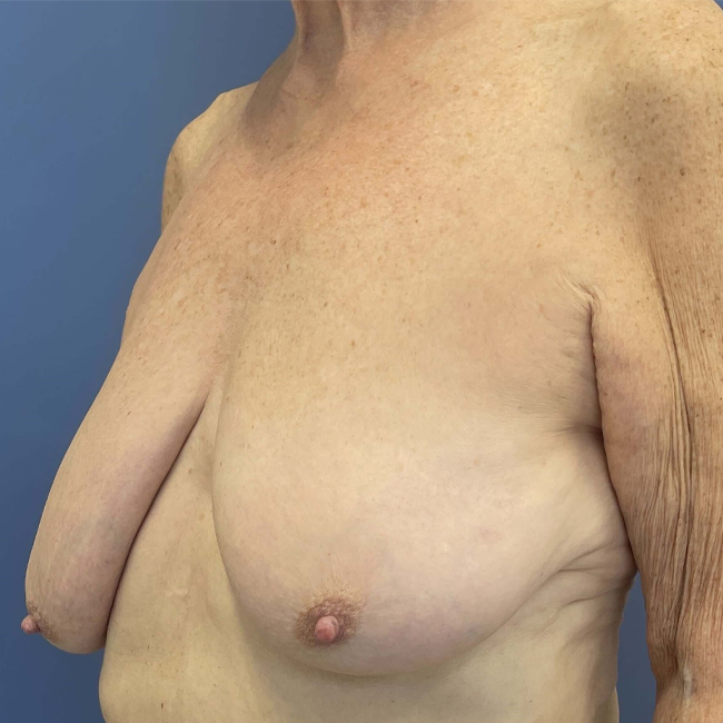 before After Weight Loss Surgery female patient left angle view case 8226
