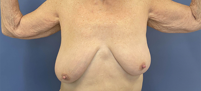 before After Weight Loss Surgery female patient front view case 8226