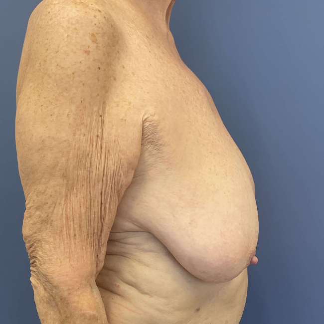 before After Weight Loss Surgery female patient right side view case 8226