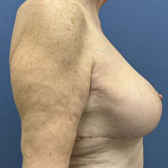 after After Weight Loss Surgery female patient right side view case 8226
