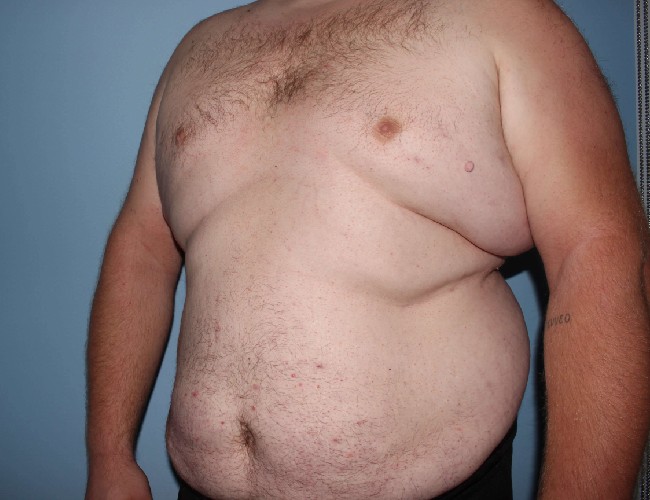 Plus Size Male Body Contouring Before and After Photos - Left Side 45 degree View Before Photo 5651