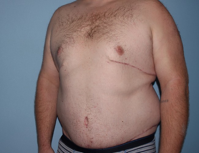 Plus Size Male Body Contouring Before and After Photos - Left Side 45 degree View After Photo 5651