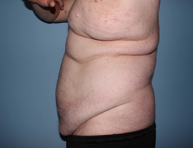 Plus Size Male Body Contouring Before and After Photos - Left Side View Before Photo 5651