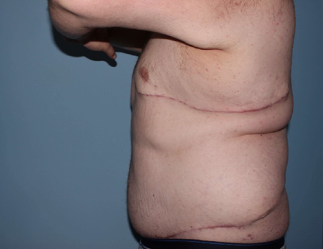 Plus Size Male Body Contouring Before and After Photos - Left Side View After Photo 5651