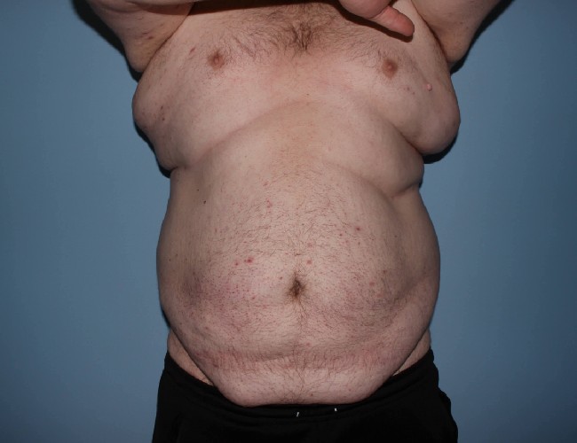 Plus Size Male Body Contouring Before and After Photos - Front Side arm raise View Before Photo 5651