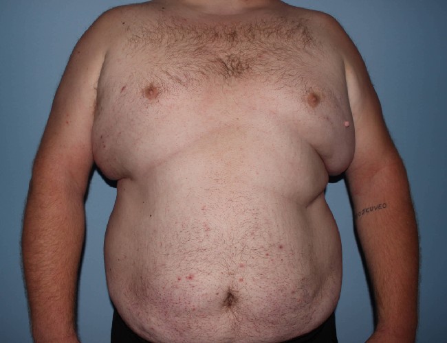 Plus Size Male Body Contouring Before and After Photos - Front Side View Before Photo 5651