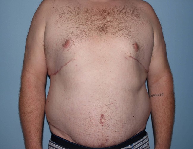 Plus Size Male Body Contouring Before and After Photos - Front Side View After Photo 5651