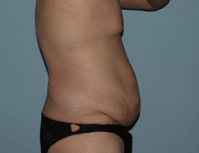 Male Abdominoplasty After Weight Loss Before and After Right Side View Before Photo 5671