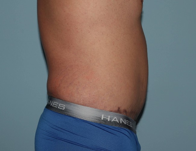 Male Abdominoplasty After Weight Loss Before and After Right Side View After Photo 5671
