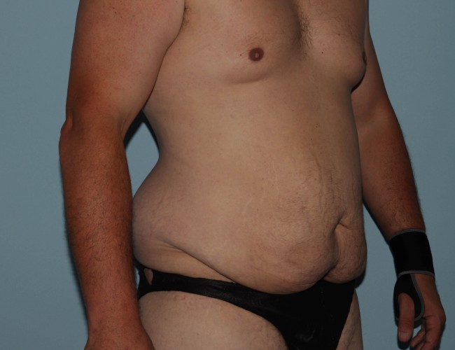 Male Abdominoplasty After Weight Loss Before and After Right Side 45 degree View Before Photo 5671