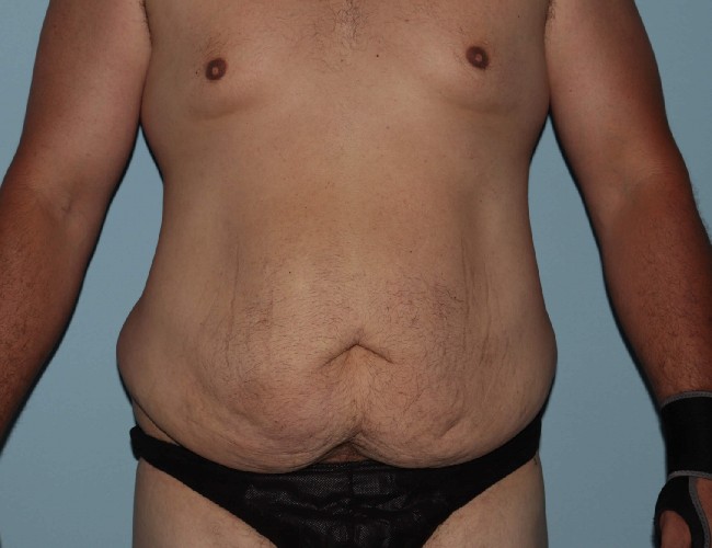 Male Abdominoplasty After Weight Loss Before and After Front Side View Before Photo 5671