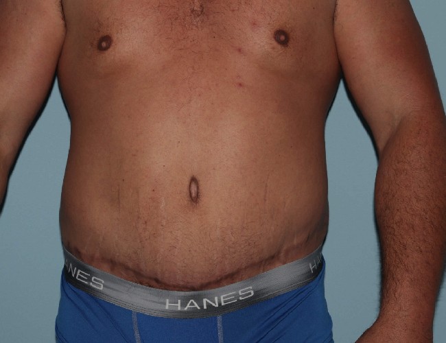 Male Abdominoplasty After Weight Loss Before and After Front Side View After Photo 5671
