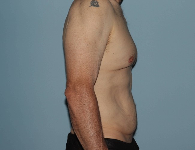 Male Abdominoplasty with Skin Tightening Before After Photos - Right Side View Before Photo 5702