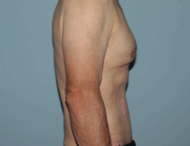 Male Abdominoplasty with Skin Tightening Before After Photos - Right Side View After Photo 5702