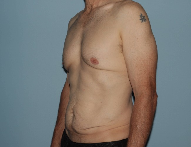 Male Abdominoplasty with Skin Tightening Before After Photos - Left Side 45 degree View Before Photo 5702