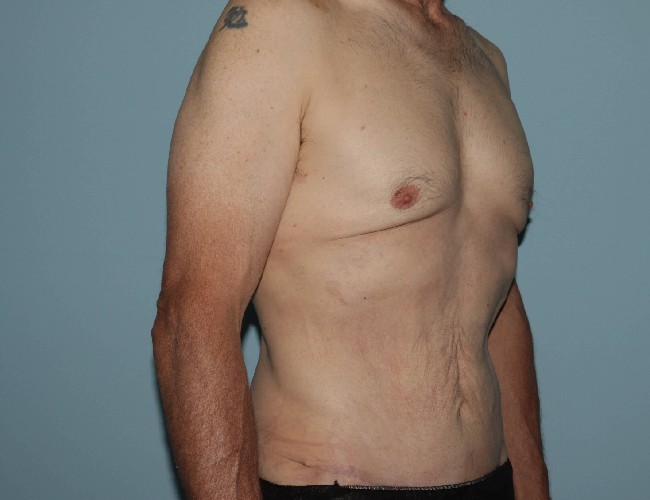 Male Abdominoplasty with Skin Tightening Before After Photos - Right Side 45 degree View After Photo 5702