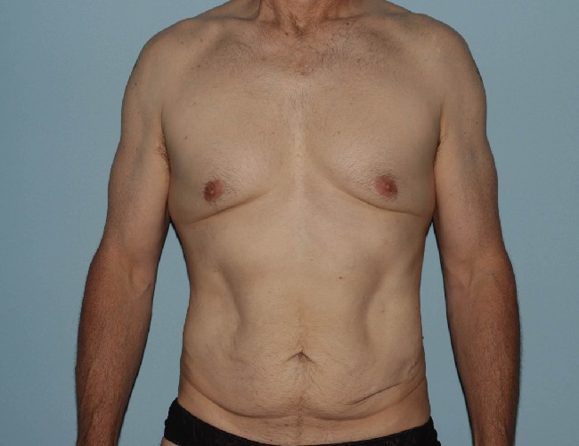 Male Abdominoplasty with Skin Tightening Before After Photos - Front Side View Before Photo 5702